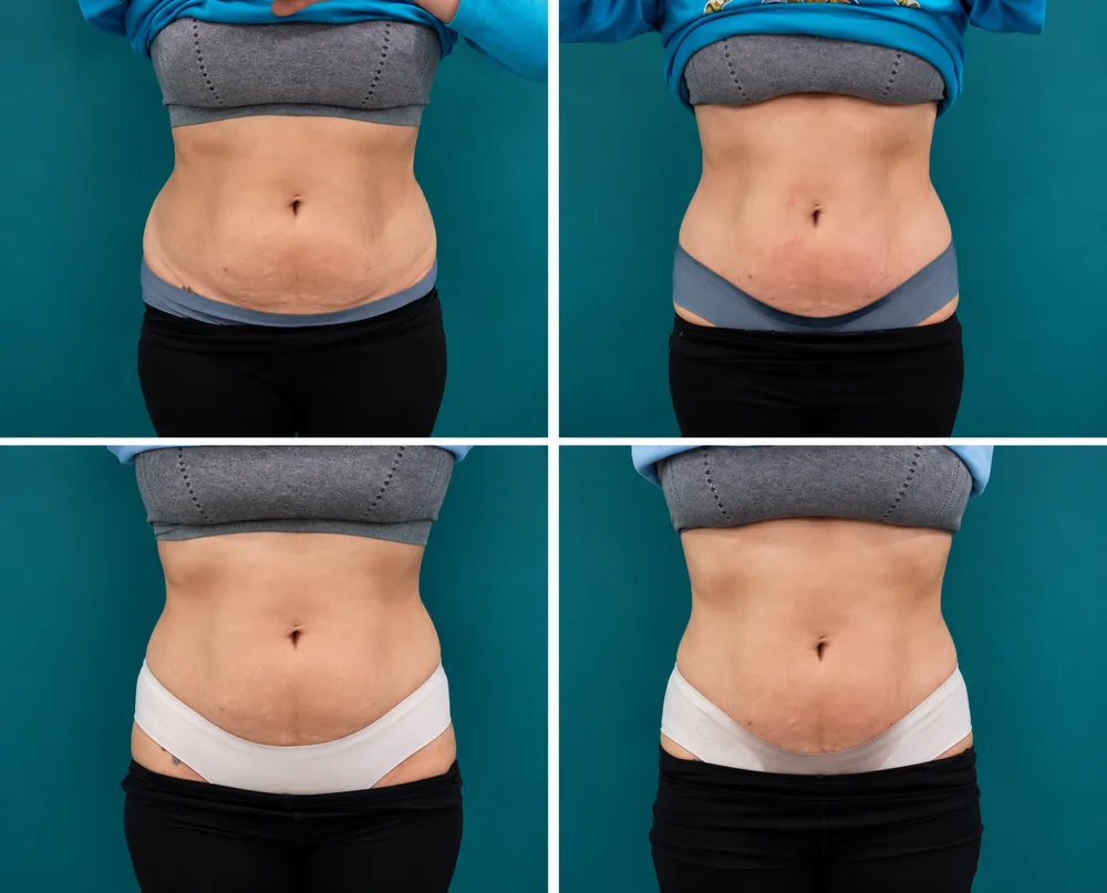 Body Dynamics client before-and-after result 15